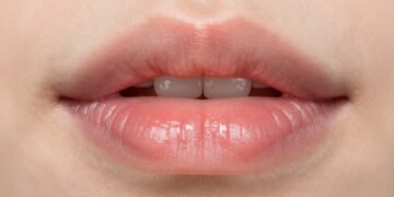 White Patch on Lips