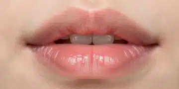 White Patch on Lips