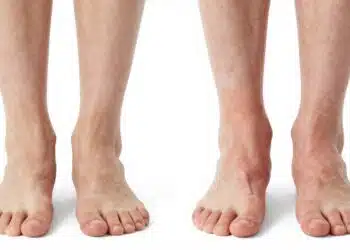 Feet and ankles swelling