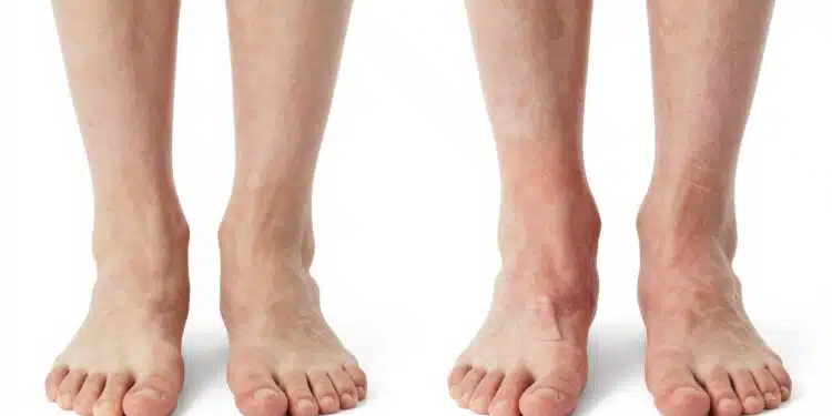Feet and ankles swelling