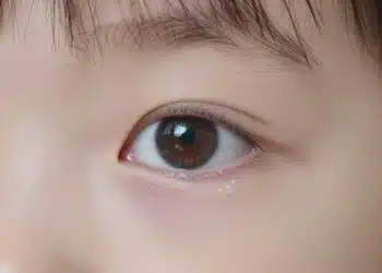 Eye Discharge in Kids