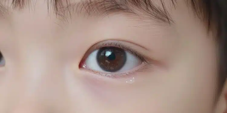 Eye Discharge in Kids