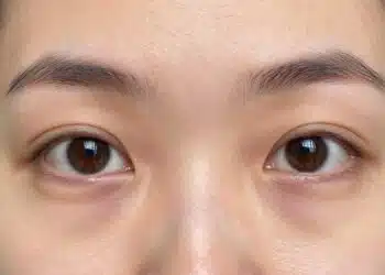 close-up of eyes with visible dark circles showing skin discoloration