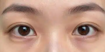 close-up of eyes with visible dark circles showing skin discoloration
