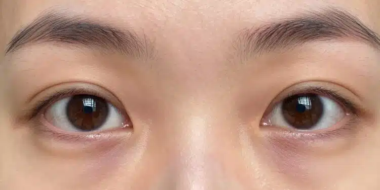 close-up of eyes with visible dark circles showing skin discoloration