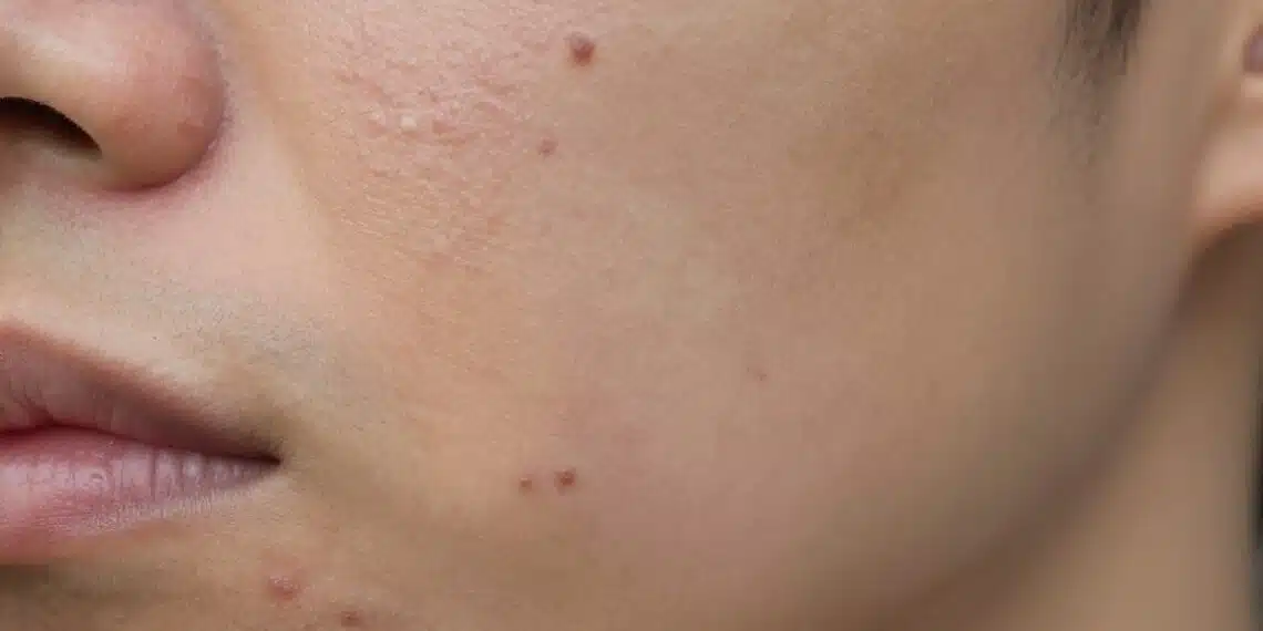 How to Finally Treat Acne Scars