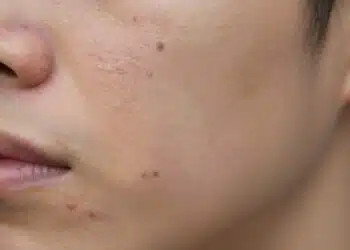 How to Finally Treat Acne Scars
