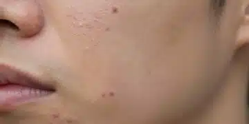 How to Finally Treat Acne Scars
