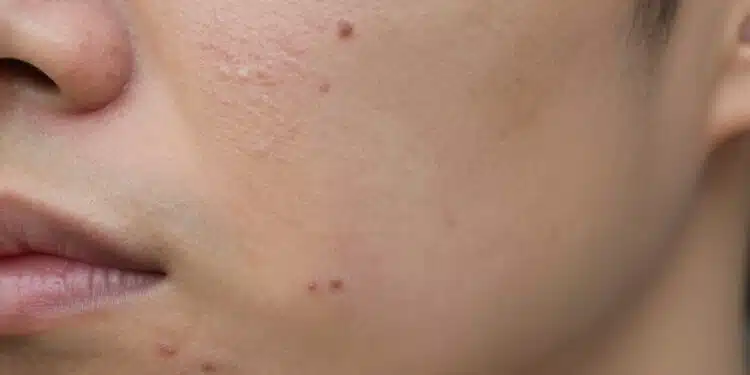 How to Finally Treat Acne Scars
