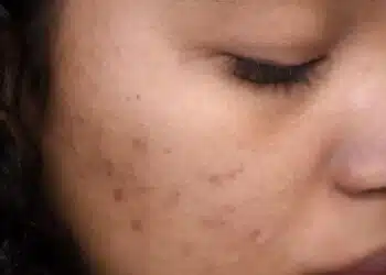 Extreme close-up of a woman's face showing skin imperfections and calm expression.