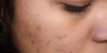 Extreme close-up of a woman's face showing skin imperfections and calm expression.