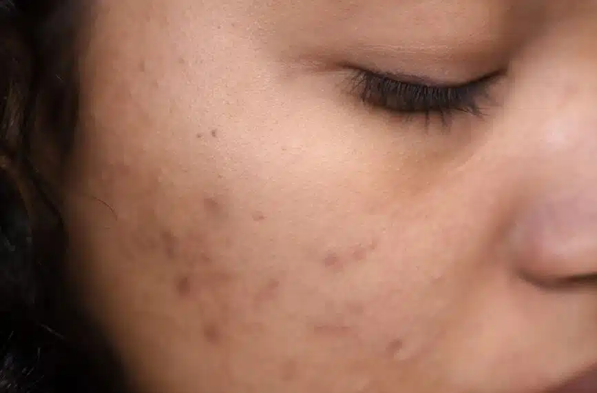 Extreme close-up of a woman's face showing skin imperfections and calm expression.