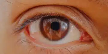 Dry eye remedies