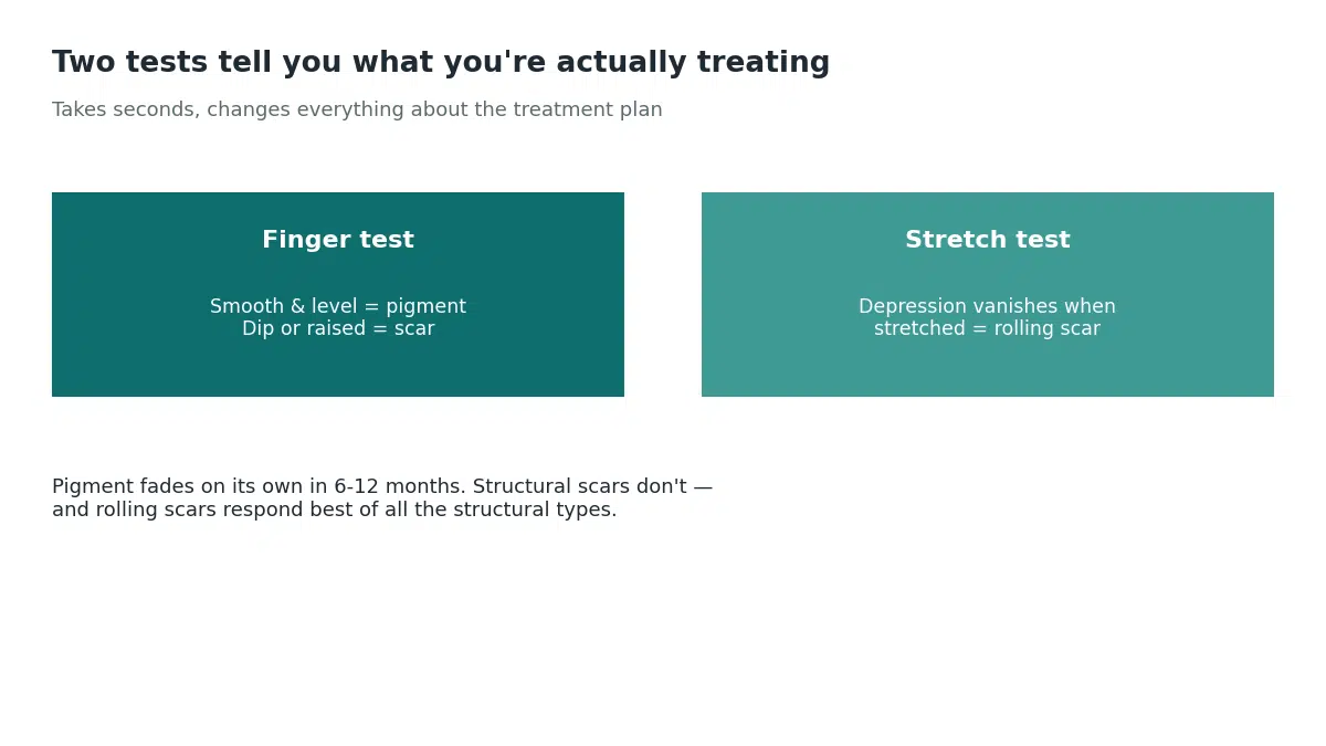The finger test shows smooth and level skin means pigmentation while a dip or raised area means a structural scar, and the stretch test shows a depression that vanishes when stretched is a rolling scar