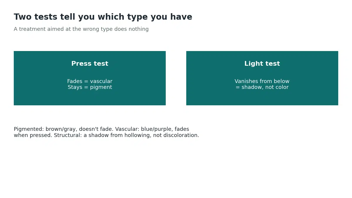 The press test shows darkness that fades when the skin is stretched is vascular while darkness that stays is pigment, and the light test shows darkness that vanishes when lit from below is shadow rather than color