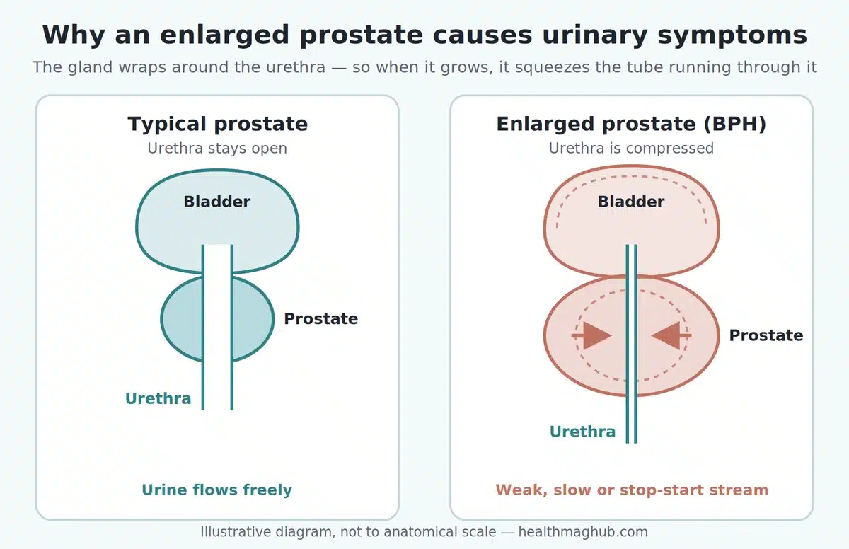 Diagram of enlarged prostate symptoms showing how the gland compresses the urethra and restricts urine flow
