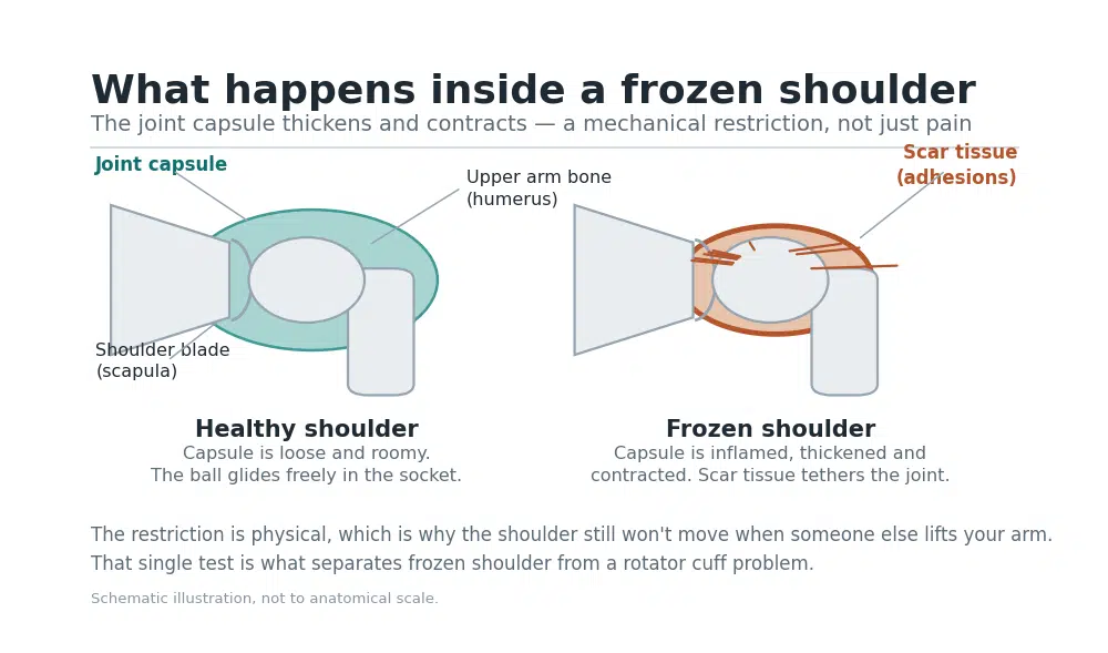 Diagram comparing a healthy shoulder joint capsule with the thickened, contracted capsule and adhesions of frozen shoulder