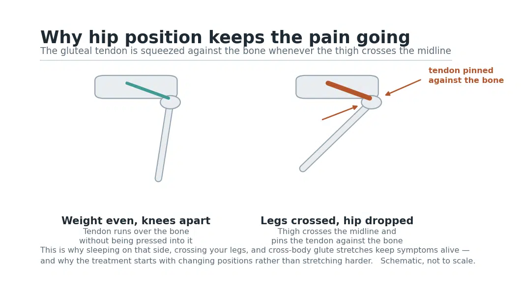Diagram showing how hip bursitis pain persists: with the thigh crossing the midline, the gluteal tendon is pinned against the greater trochanter