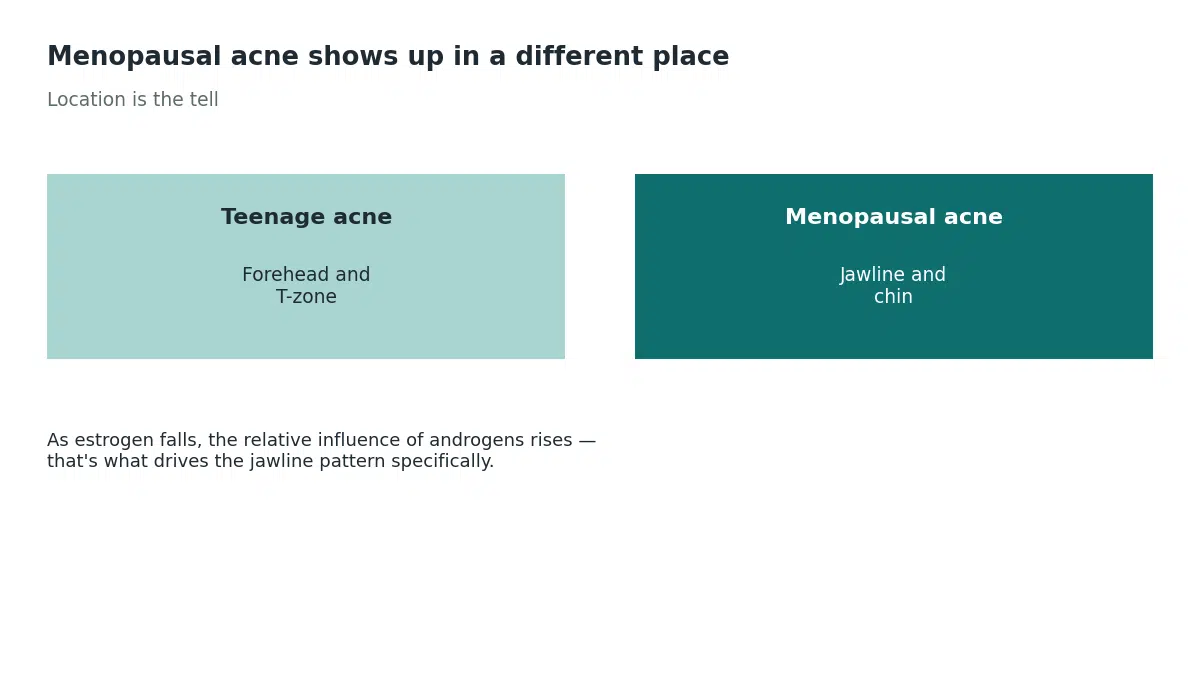 Teenage acne shows up on the forehead and T-zone while menopausal acne appears along the jawline and chin, because falling estrogen raises the relative influence of androgens