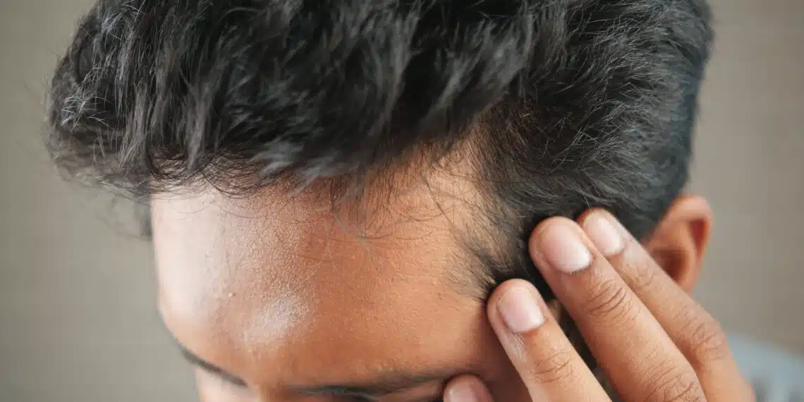 Creatine Hair Loss
