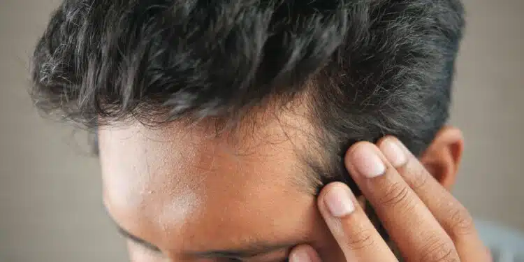 Creatine Hair Loss