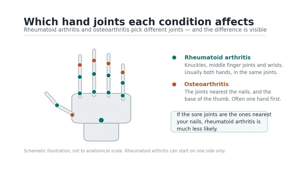 Hand diagram showing which joints rheumatoid arthritis affects — knuckles, middle finger joints and wrist — versus the joints nearest the nails, which osteoarthritis affects