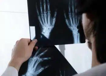 Rheumatoid Arthritis