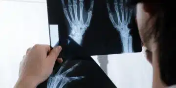 Rheumatoid Arthritis