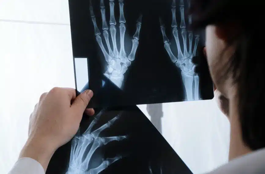 Rheumatoid Arthritis
