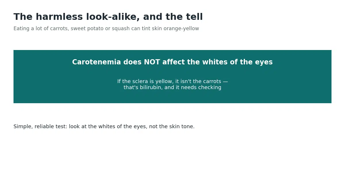 Carotenemia from eating a lot of carrots or squash can tint the skin orange-yellow but never affects the whites of the eyes, so yellow sclera always means bilirubin rather than diet